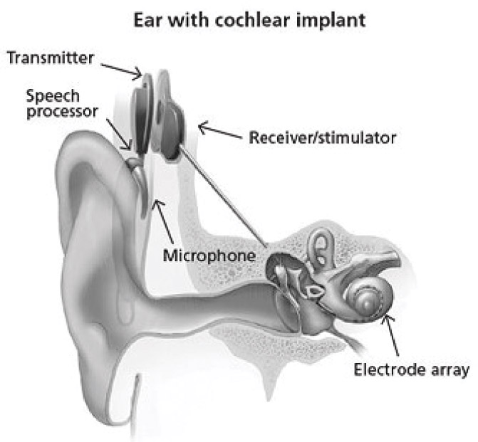 [MISSING IMAGE: ph_cochleardiag-bwlr.jpg]